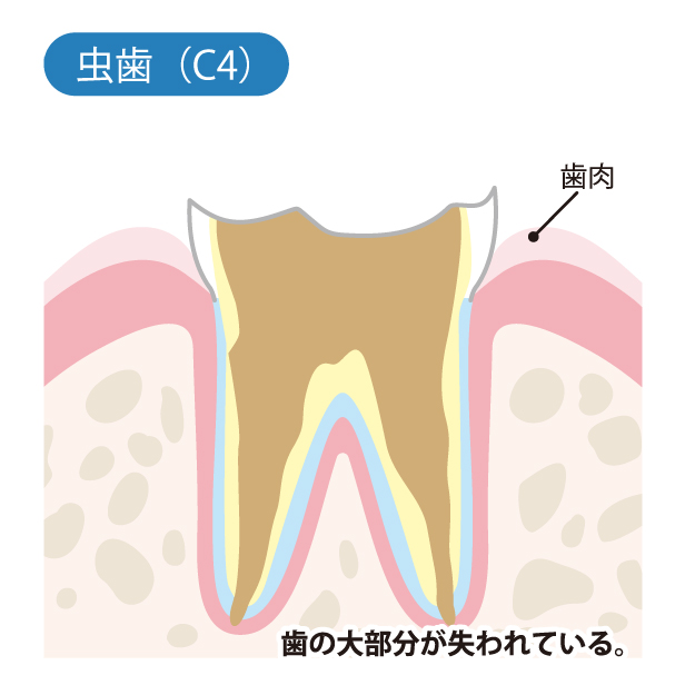 C4 歯の根元だけが残る（残根）/歯の根の先に膿（うみ）がたまる（膿瘍）
